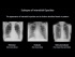 Diffuse Lung Processes