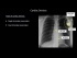 Atelectasis, Lines, Tubes, Devices, and Surgeries