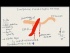 Superior Mesenteric Syndrome (USMLE Tutorial)