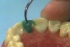 Waxing a Maxillary Central Incisor