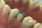 Waxing a Maxillary Second Bicuspid