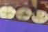 Mandibular Molars II