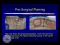 DENT 718: Implant-supported dentures