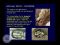 DENT 718: Classification and components of removable partial dentures
