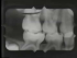 Pedodontic Radiographic Interpretation