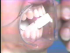 Periapical Radiography: Long Cone Paralleling Technique