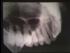 Occlusal Radiography