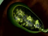Gallstones